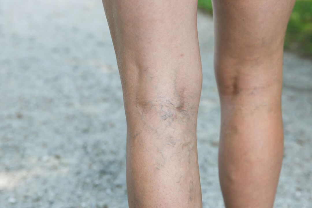With varicose veins, the exercise program should be discussed with the doctor. 